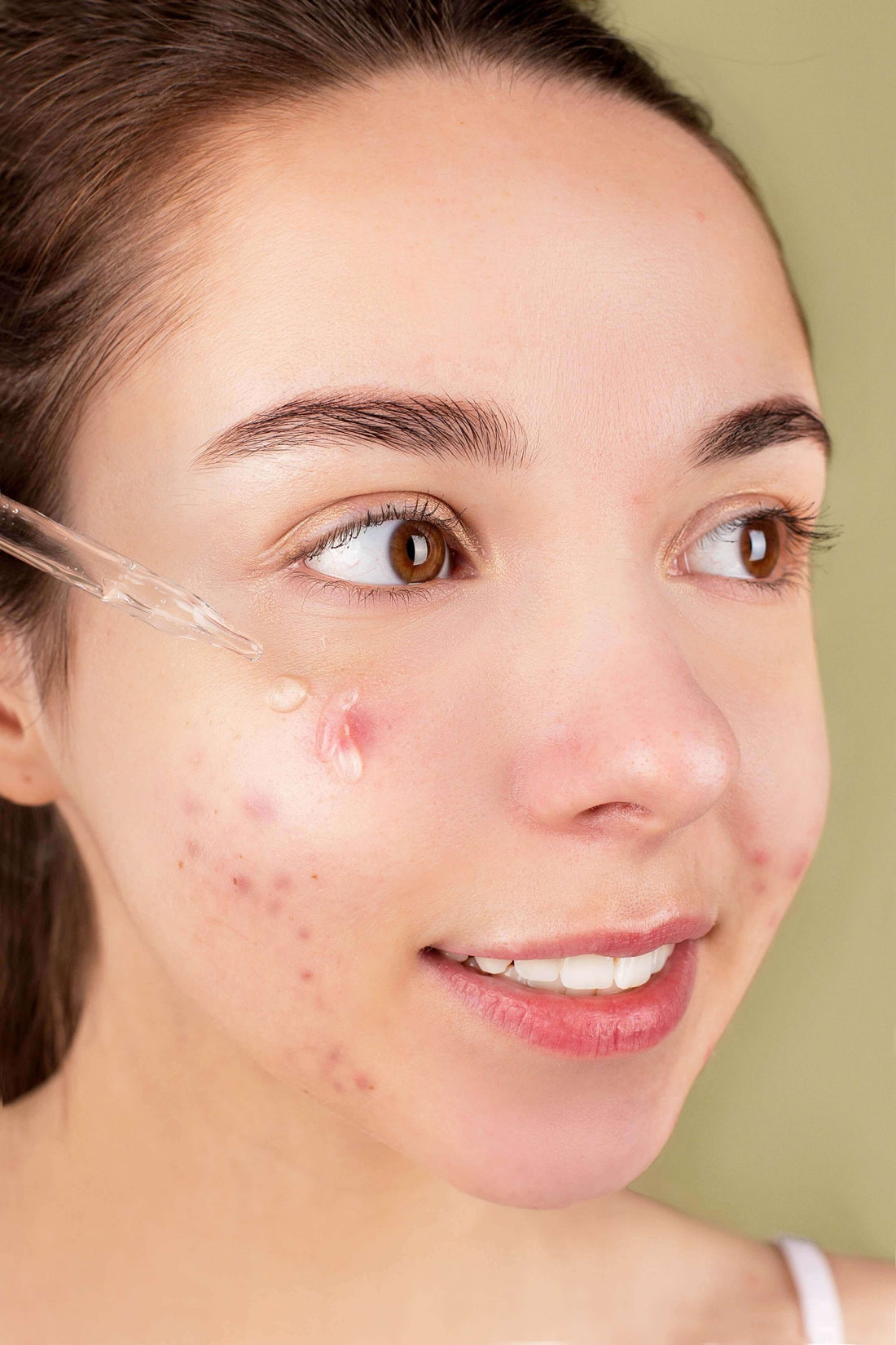 Natural Acne Treatment: Zhiiva Skincare